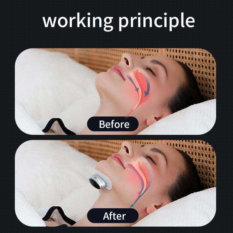 Better Sleep Apnea Aid Treatment Tool Breathing Corrector Smart Snoring Stopper Anti Snore Devices - Image 2